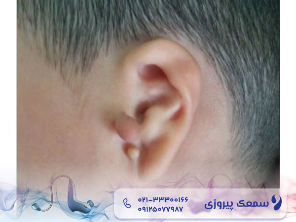 آتزری کانال گوش